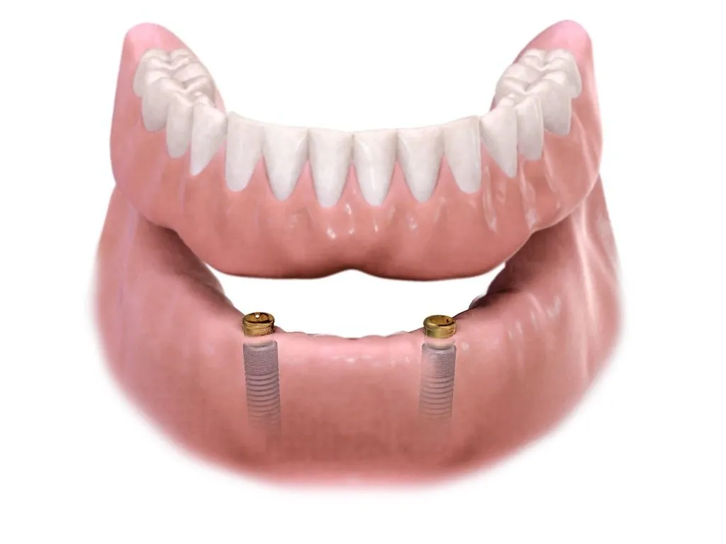 Implant-retained overdenture and dental implants